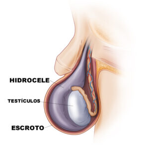 Tratamento Hidrocele
